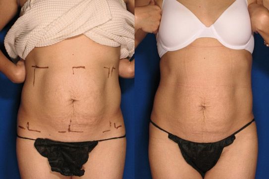 EXILIS Stomach Skin Tightening - £99